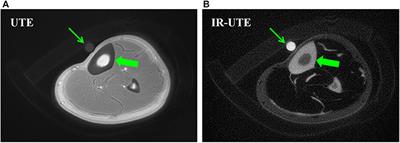 Quantitative Ultrashort Echo Time (UTE) Magnetic Resonance Imaging of Bone: An Update